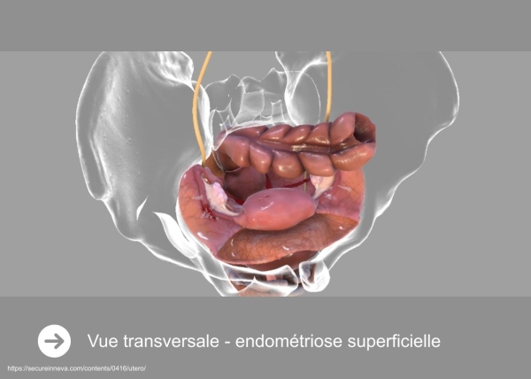 Définitions, localisation et épidémiologie
