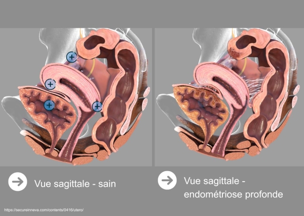 Définitions, localisation et épidémiologie