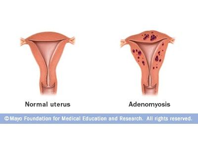 Adénomyose